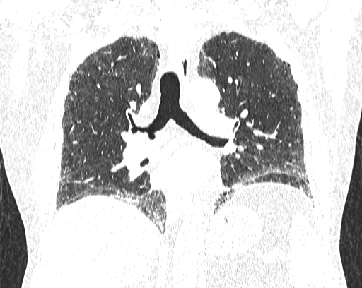 Non-specific interstitial pneumonia (NSIP) (Radiopaedia 68599-78228 Coronal lung window 54).jpg