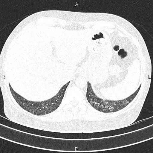 Non-specific interstitial pneumonia (Radiopaedia 83185-97567 Axial lung window 57).jpg