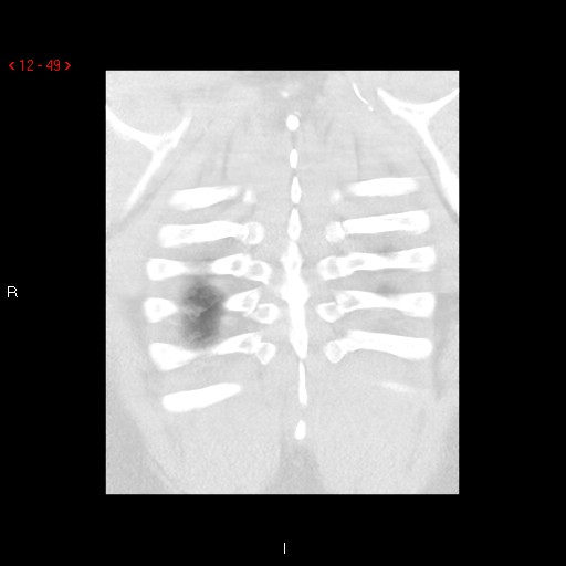 File:Non-specific interstitial pneumonitis (Radiopaedia 27044-27222 Coronal lung window 49).jpg