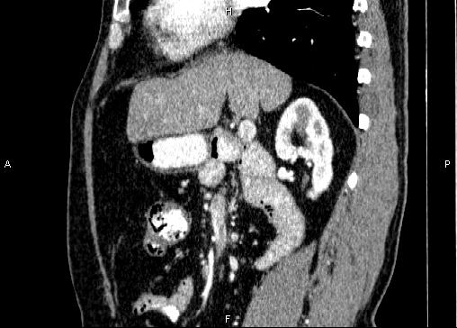 Non-syndromic pancreatic endocrine tumor (Radiopaedia 86958-103178 E 41).jpg