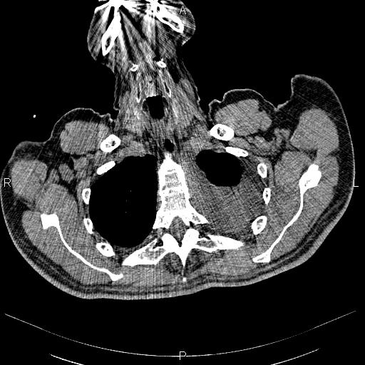 File:Non Hodgkin lymphoma in a patient with ankylosing spondylitis (Radiopaedia 84323-99621 Axial non-contrast 3).jpg