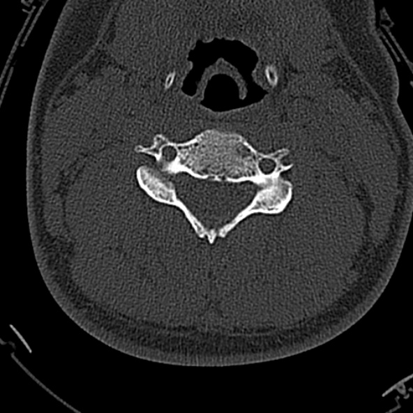 Normal CT of the cervical spine (Radiopaedia 53322-59305 Axial bone window 135).jpg