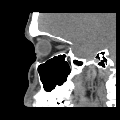 Normal CT paranasal sinuses (Radiopaedia 42286-45390 F 99).jpg
