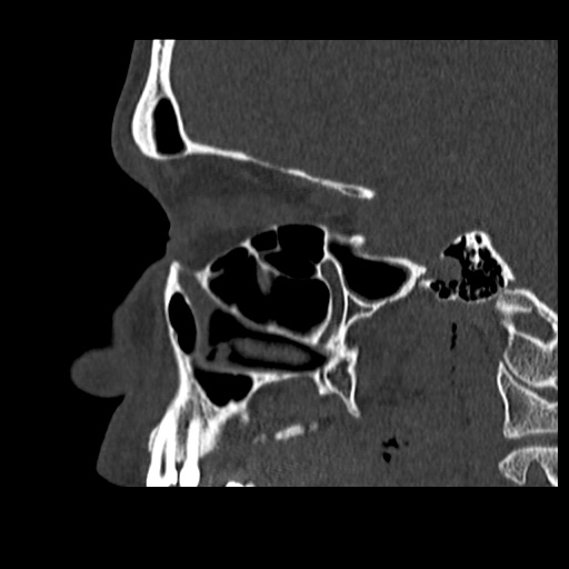 Normal CT paranasal sinuses (Radiopaedia 42286-45390 Sagittal bone window 68).jpg