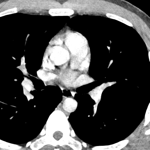 File:Normal CT pulmonary veins (pre RF ablation) (Radiopaedia 41748-44702 A 106).png