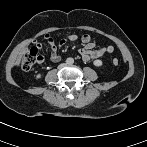 File:Normal CT split bolus study of the renal tract (Radiopaedia 48631-53634 Axial split bolus 158).jpg