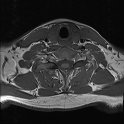 File:Normal MRI cervical spine (infection protocol) (Radiopaedia 53916-60039 Axial 38).png