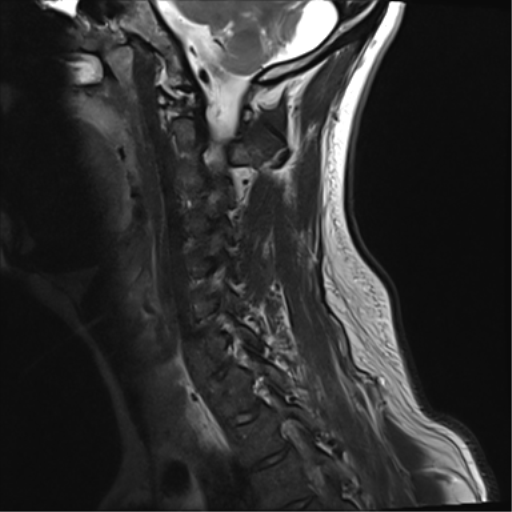 File:Normal MRI cervical spine (infection protocol) (Radiopaedia 53916-60039 Sagittal T2 12).png