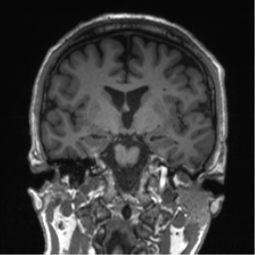 Normal brain MRI (non-focal epilepsy protocol) (Radiopaedia 53917-60040 Coronal T1 37).png