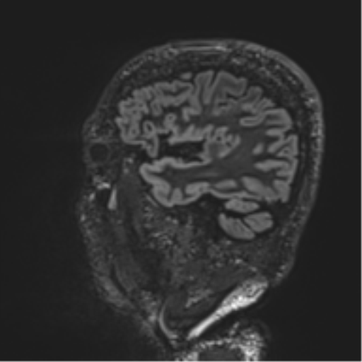 Normal brain MRI (non-focal epilepsy protocol) (Radiopaedia 53917-60040 Sagittal DIR 17).png
