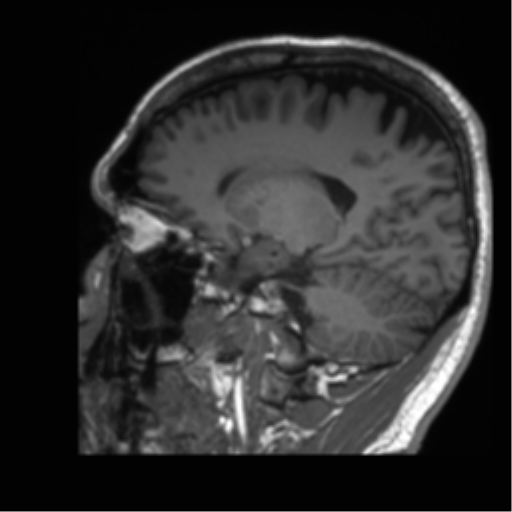 Normal brain MRI (non-focal epilepsy protocol) (Radiopaedia 53917-60040 Sagittal T1 24).png