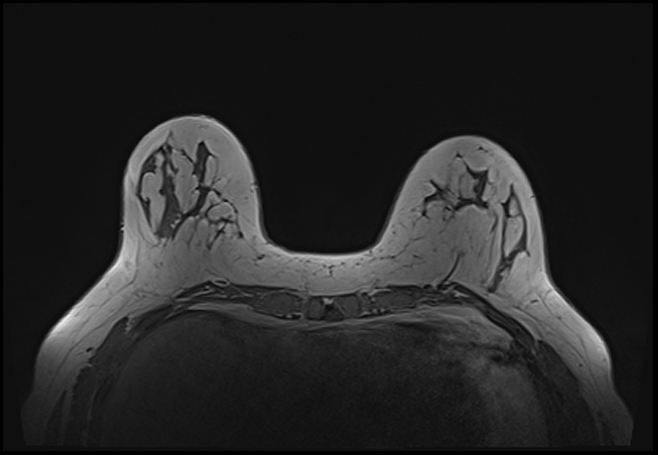 File:Normal breast MRI - dense breasts (Radiopaedia 80454-93850 Axial T1 63).jpg