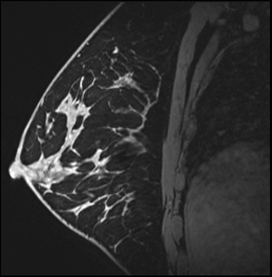 Normal breast MRI - dense breasts (Radiopaedia 80454-93850 I 116).jpg