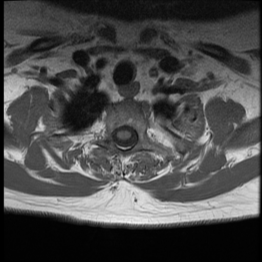 File:Normal cervical and thoracic spine MRI (Radiopaedia 35630-37156 Axial T1 5).png