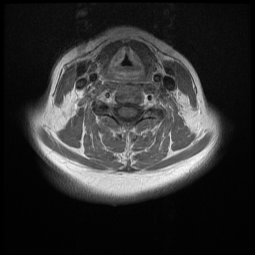 File:Normal cervical and thoracic spine MRI (Radiopaedia 35630-37156 Axial T1 C+ 17).png