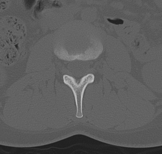 File:Normal lumbar spine CT (Radiopaedia 46533-50986 Axial bone window 28).png