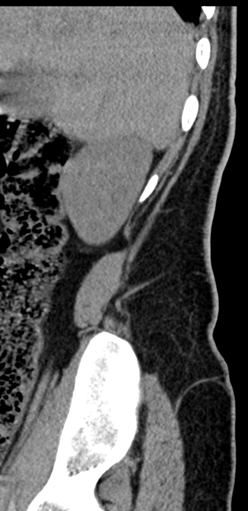 Normal lumbosacral CT (Radiopaedia 37923-39867 E 104).png
