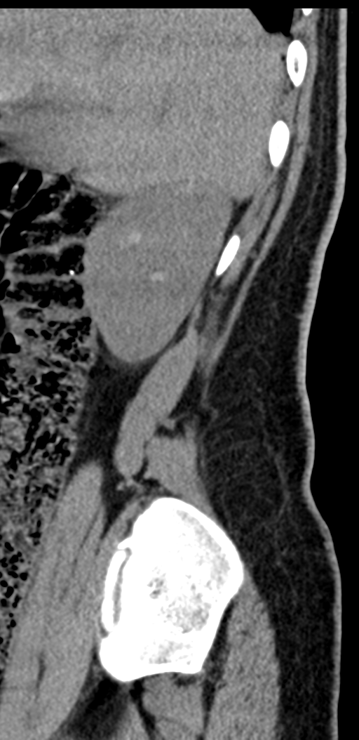 Normal lumbosacral CT (Radiopaedia 37923-39867 E 99).png