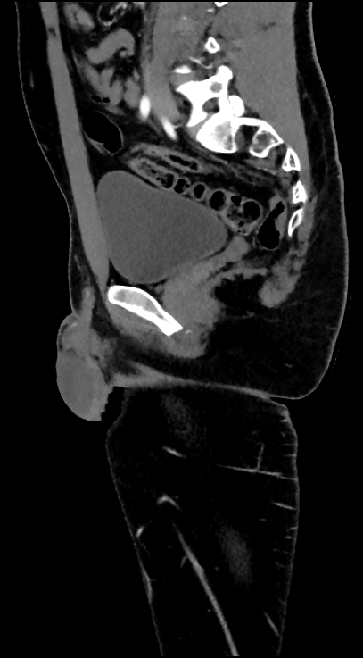 Normal pelvis CT angiogram (Radiopaedia 84966-100481 C 49).jpg