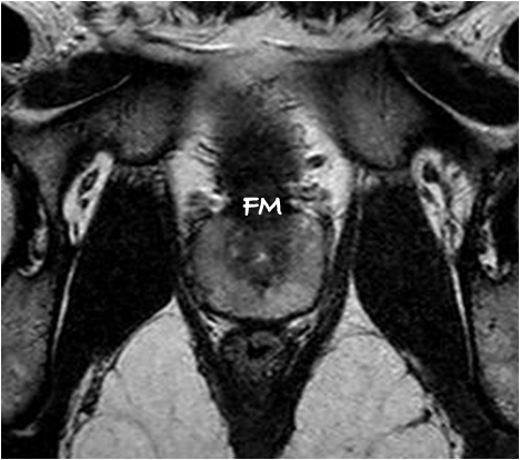 File:Normal prostate (MRI) (Radiopaedia 29986-30536 E 1).png