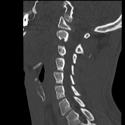 File:Normal trauma cervical spine (Radiopaedia 41017-43760 Sagittal bone window 30).png