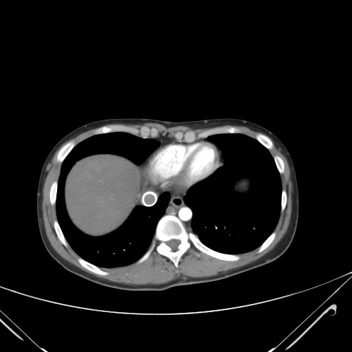 File:Nutmeg liver- Budd-Chiari syndrome (Radiopaedia 46234-50635 A 6).png