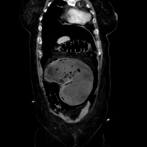 Obstructive distal colonic adenocarcinoma causing cecal perforation (Radiopaedia 86830-102989 C 57).jpg