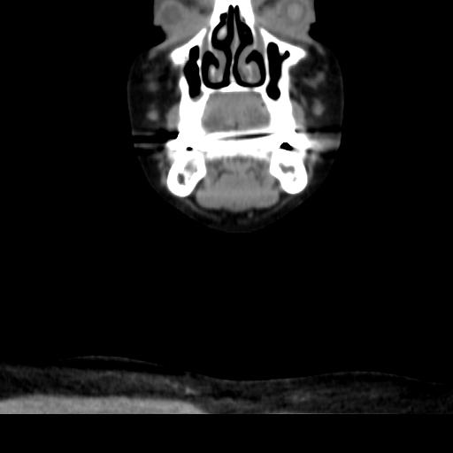 File:Obstructive sleep apnea (CT evaluation) (Radiopaedia 24304-24582 Coronal non-contrast 24).jpg