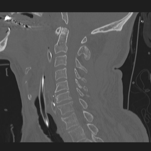 File:Occipital condyle fracture (Radiopaedia 33467-34517 Sagittal bone window 34).png