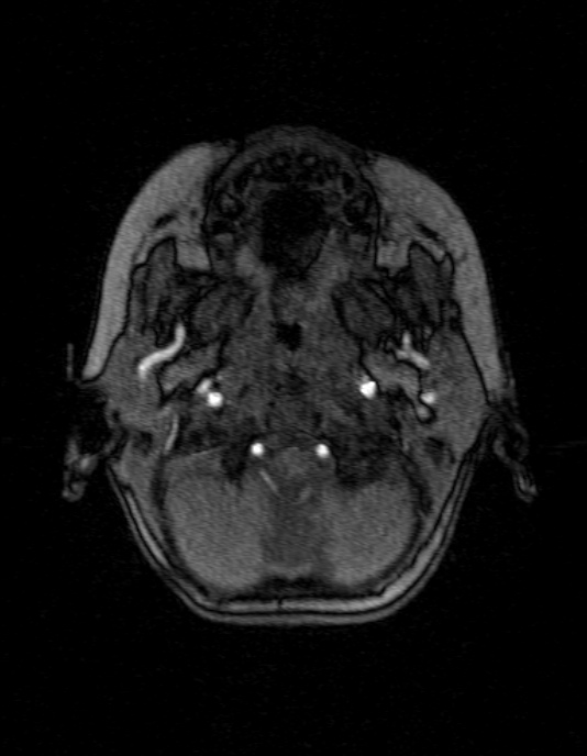 Occipital horn syndrome (Radiopaedia 14255-14129 MRA 15).jpg