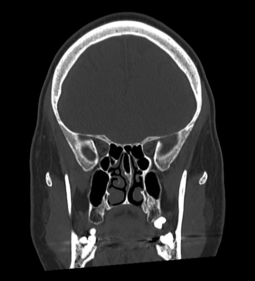 Occipital spur and Currarino type A atlas anomaly (Radiopaedia 87027-103285 Coronal bone window 58).jpg