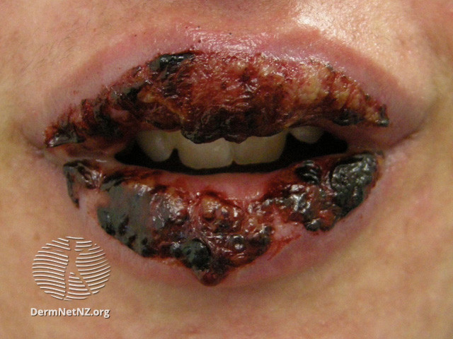 File:Stomatitis due to toxic epidermal necrolysis (DermNet NZ site-age-specific-ten-stomatitis).jpg