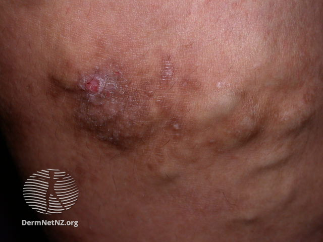File:Varicose eczema (DermNet NZ varicose-veins-05).jpg