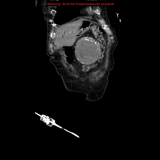 Abdominal aortic aneurysm- extremely large, ruptured (Radiopaedia 19882-19921 Coronal C+ arterial phase 15).jpg
