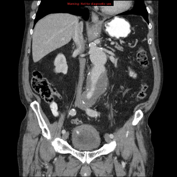 File:Abdominal aortic aneurysm (Radiopaedia 10122-10660 Coronal C+ portal venous phase 23).jpg