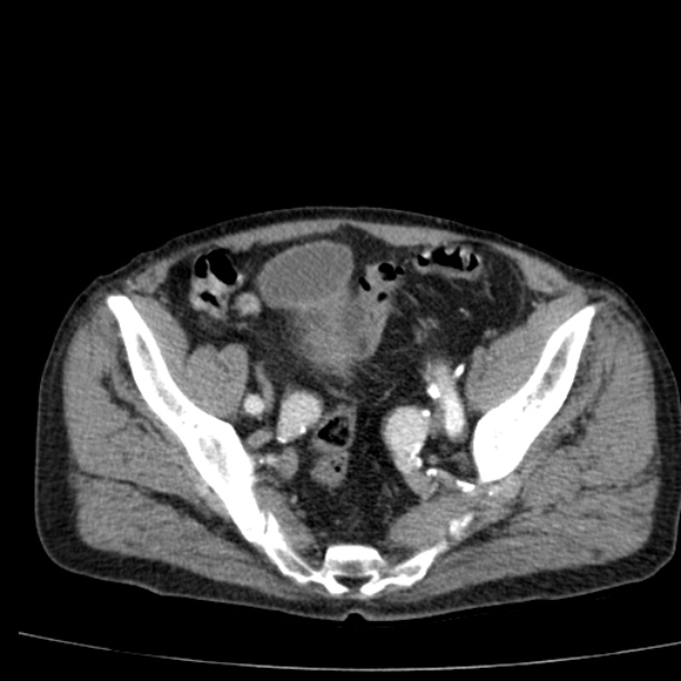 Abdominal aortic aneurysm (Radiopaedia 29248-29660 Axial C+ arterial phase 73).jpg