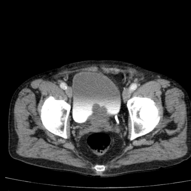 Abdominal aortic aneurysm (Radiopaedia 29248-29660 Axial C+ arterial phase 83).jpg