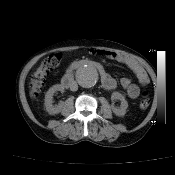 Abdominal aortic aneurysm (Radiopaedia 29248-29660 Axial non-contrast 28).jpg