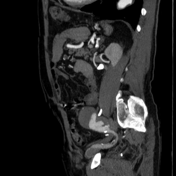 Abdominal aortic aneurysm (Radiopaedia 29248-29660 Sagittal C+ arterial phase 37).jpg