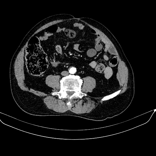 Abdominal aortic aneurysm (Radiopaedia 67117-76452 Axial C+ arterial phase 85).jpg