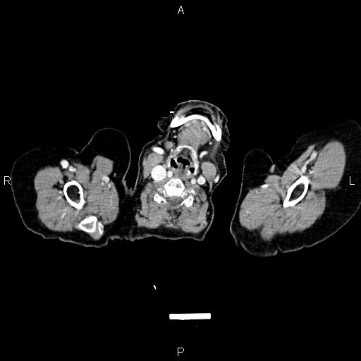 File:Abdominal aortic aneurysm (Radiopaedia 85063-100606 Axial C+ portal venous phase 1).jpg