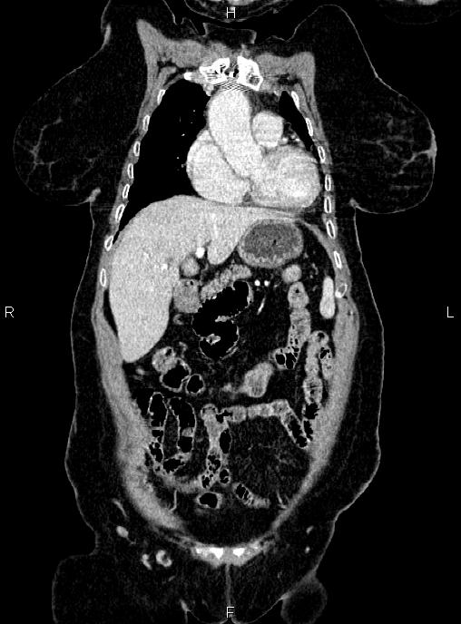 Abdominal aortic aneurysm (Radiopaedia 85063-100606 Coronal C+ arterial phase 12).jpg