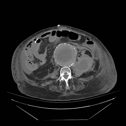 Abdominal aortic aneurysm - impending rupture (Radiopaedia 19233-19247 Axial non-contrast 99).jpg