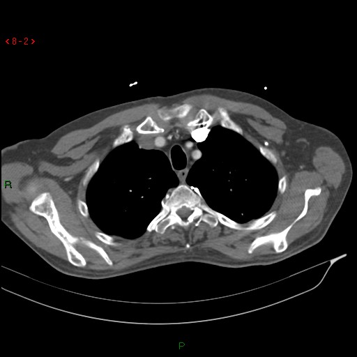 Abdominal aortic aneurysm rupture with aortocaval fistula (Radiopaedia 14897-14841 Axial C+ arterial phase 2).jpg