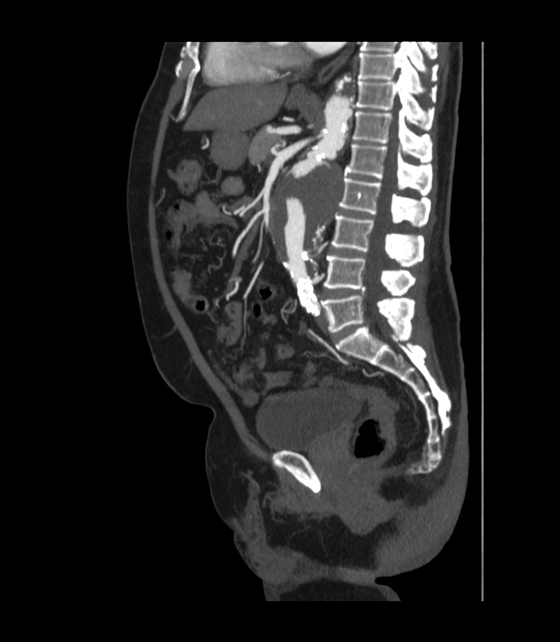 Abdominal aortic aneurysm with thrombus fissuration (Radiopaedia 46218-50618 Sagittal C+ arterial phase 31).jpg
