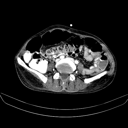File:Abdominal collection due to previous cecal perforation (Radiopaedia 80831-94320 Axial C+ portal venous phase 128).jpg