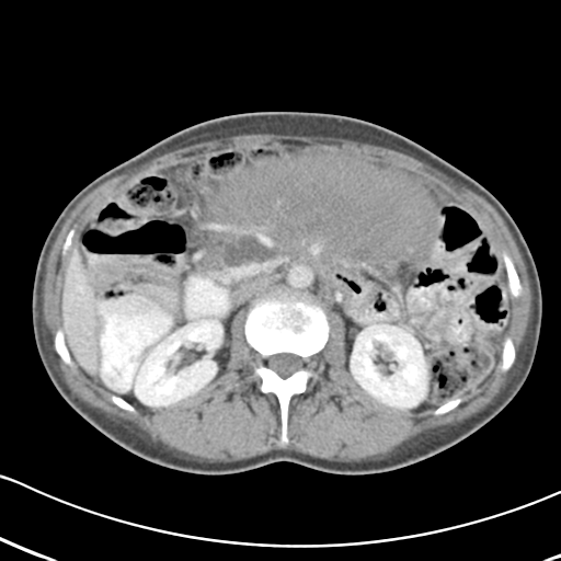 Abdominal desmoid tumor (Radiopaedia 41007-43740 Axial C+ portal venous phase 25).png