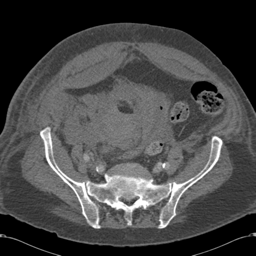 File:Abdominal hematoma (Radiopaedia 33614-34715 Axial C+ portal venous phase 94).png