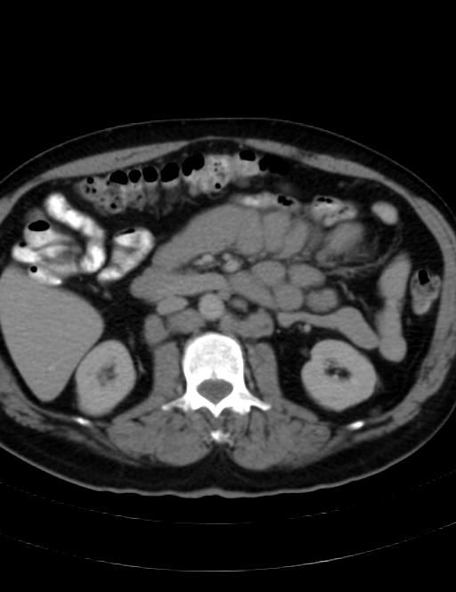 Abdominal lymphoma - with sandwich sign (Radiopaedia 53486-59492 Axial C+ portal venous phase 23).jpg