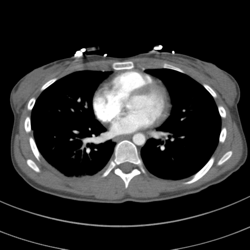 File:Abdominal multi-trauma - devascularised kidney and liver, spleen and pancreatic lacerations (Radiopaedia 34984-36486 Axial C+ arterial phase 51).png